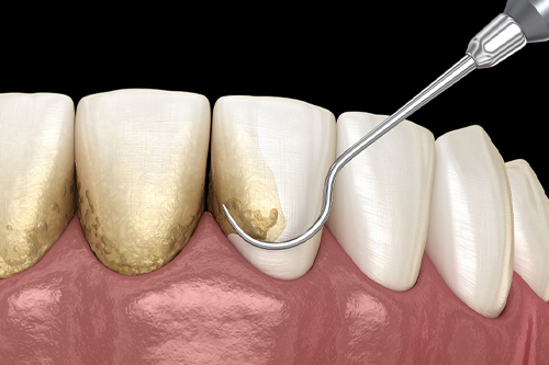 クリーニングの症例